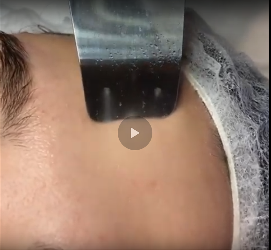 Peeling kawitacyjny